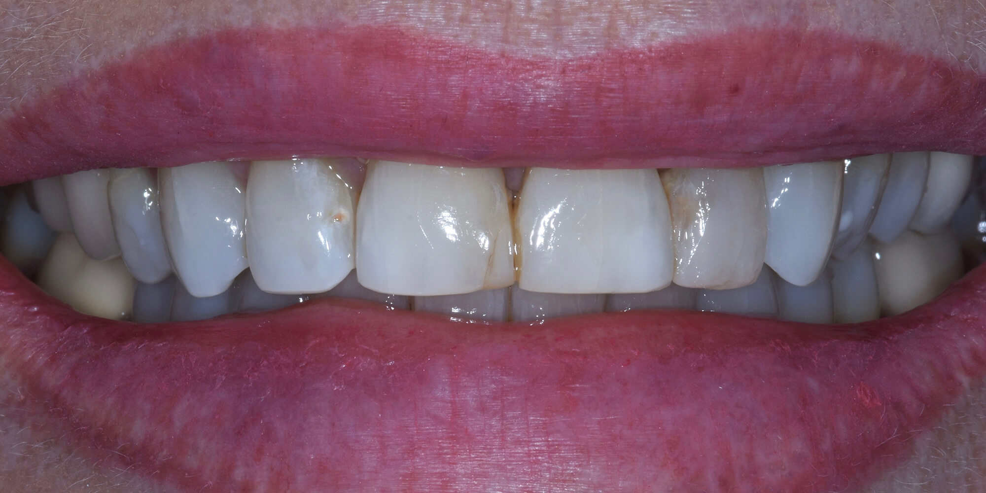 facettes dentaire cannes Dr Slim Haffani Chirurgien Dentiste